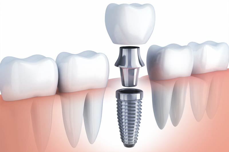 Dental Implants in San Antonio
